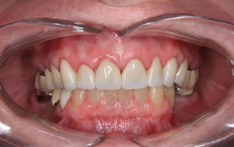 All-Ceramic-Restorations-After-Image