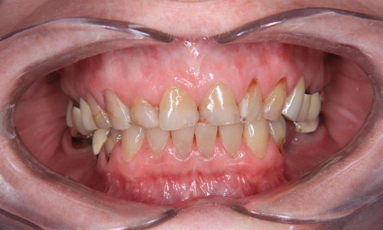 All-Ceramic-Restorations-Before-Image